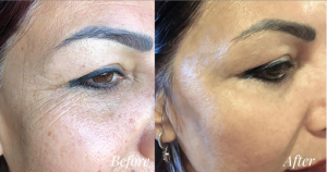 MRVL top anti aging cream before and after results